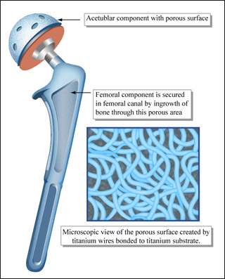 Drawing of hip implant, highlighting porous surfaces for tissue ingrowth. Drawing of hip implant, highlighting porous surfaces for tissue ingrowth.